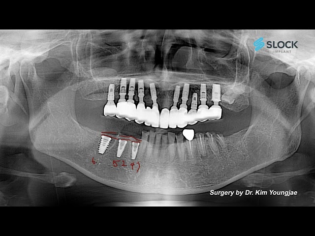 SLOCK 임플란트 수술 가이드 – 하악 구치부 임플란트 케이스