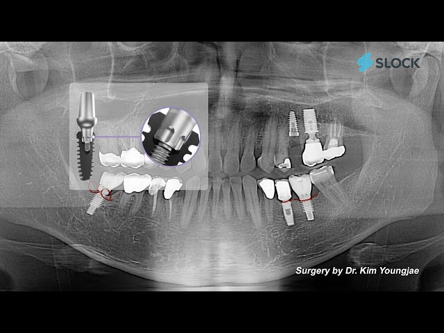 SLOCK 임플란트 수술 가이드 – 상악 소구치 임플란트 케이스