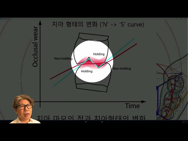 임플란트 교합 – 2
